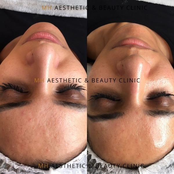 Hydrafacial - Skin Health for Life, Hydradermabrasion Information